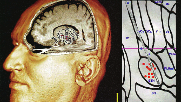 Figure 1 - Brain scan: A 3-D reconstruction of an MRI image of the brain of a patient who has received deep-brain stimulation treatment for tremor caused by Parkinson’s disease.