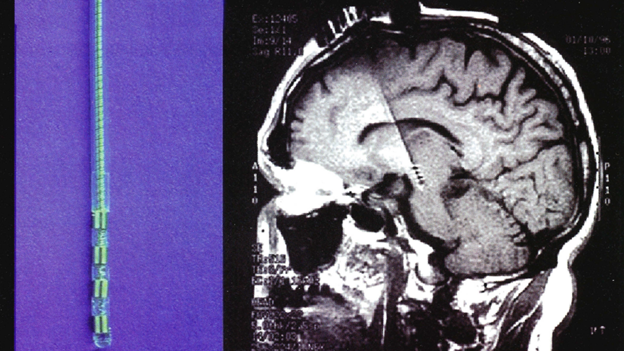 Figure 2 - Deep impact: The deep-brain stimulator (left) is an electrode the size of a hair, the MRI shows the trajectory of the stimulator implanted in the subthalamic nucleus.